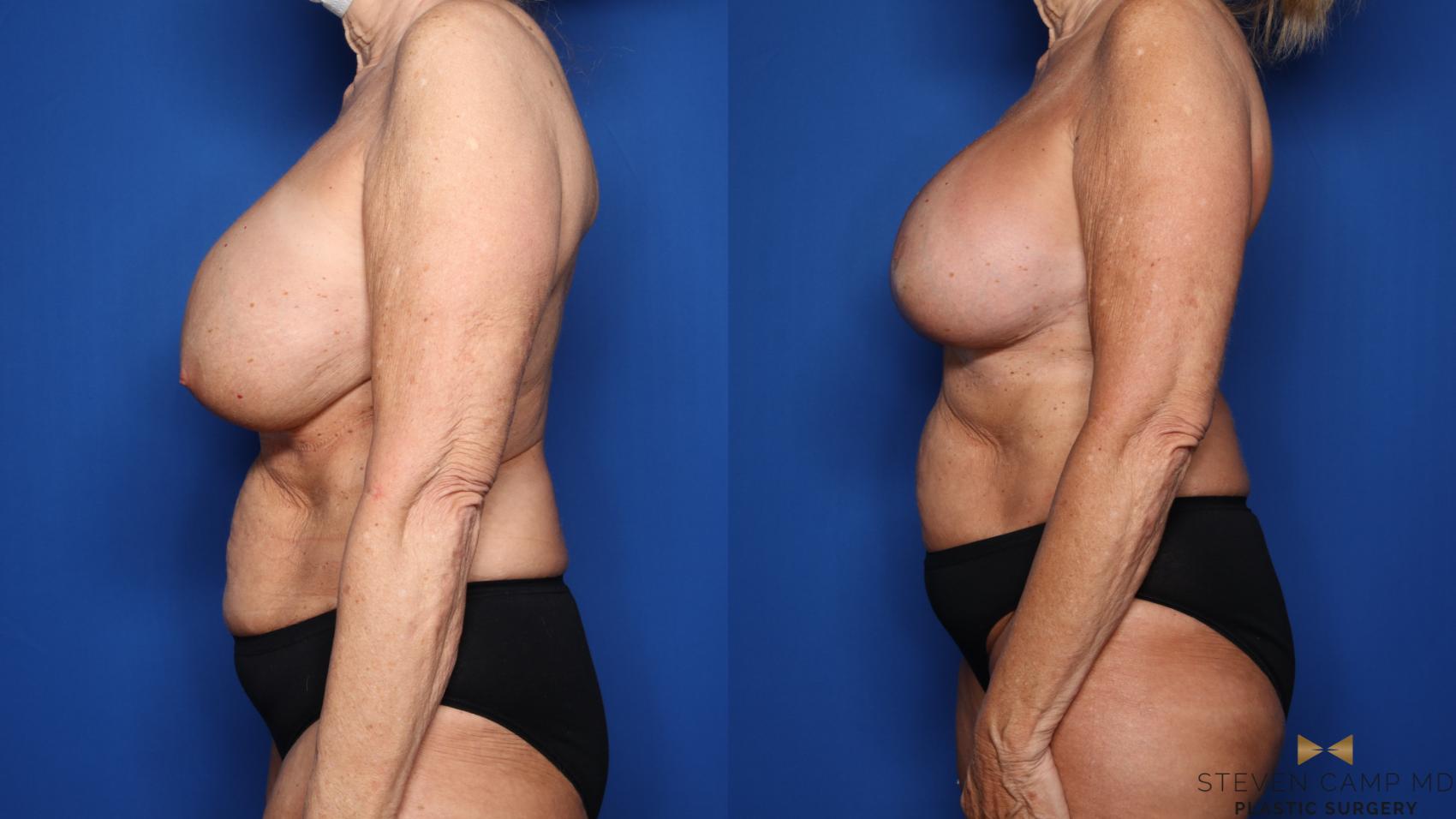 Before & After Breast Implant Exchange (Breast Revision) Case 553 Left Side View in Fort Worth & Arlington, Texas