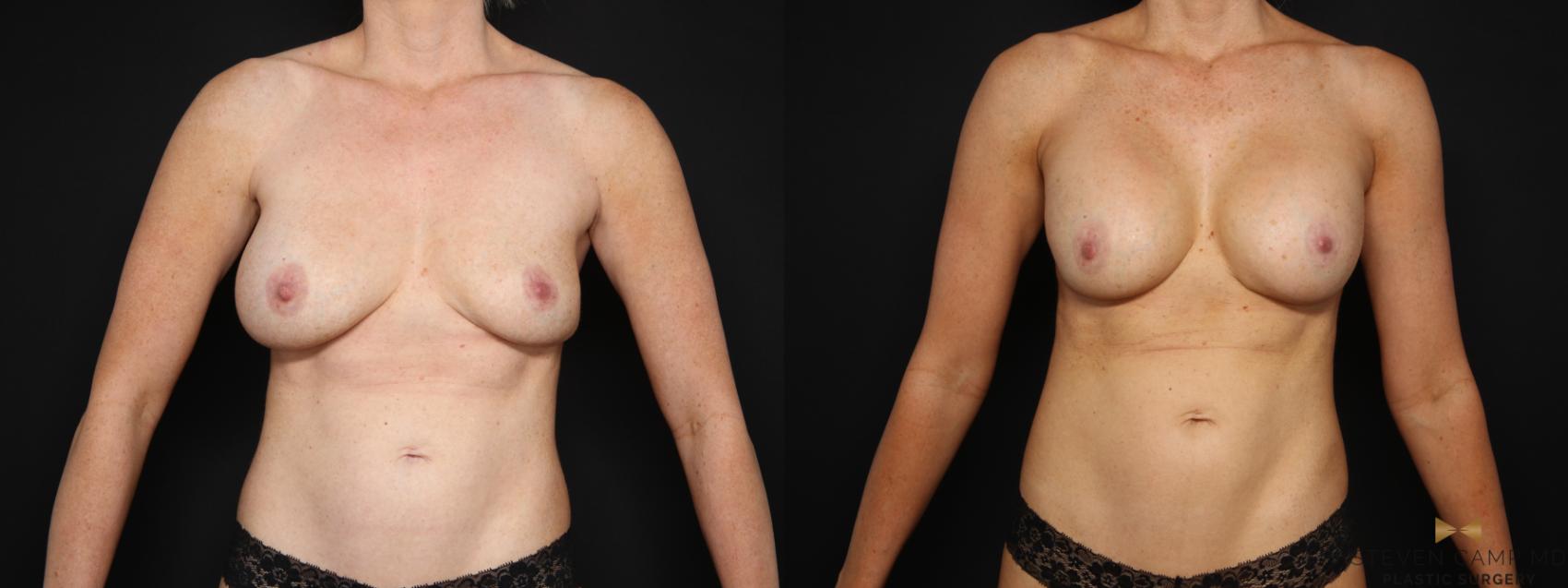 Before & After Breast Implant Exchange (Breast Revision) Case 675 Front View in Fort Worth & Arlington, Texas