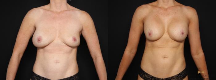 Before & After Breast Implant Exchange (Breast Revision) Case 675 Front View in Fort Worth & Arlington, Texas