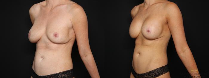 Before & After Breast Implant Exchange (Breast Revision) Case 675 Left Oblique View in Fort Worth & Arlington, Texas