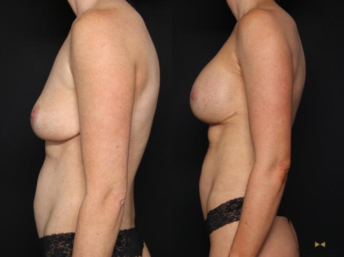 Before & After Breast Implant Exchange (Breast Revision) Case 675 Left Side View in Fort Worth & Arlington, Texas