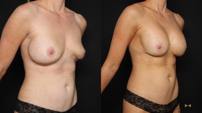 Before & After Breast Implant Exchange (Breast Revision) Case 675 Right Oblique View in Fort Worth & Arlington, Texas