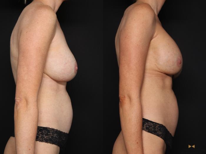 Before & After Breast Implant Exchange (Breast Revision) Case 675 Right Side View in Fort Worth & Arlington, Texas