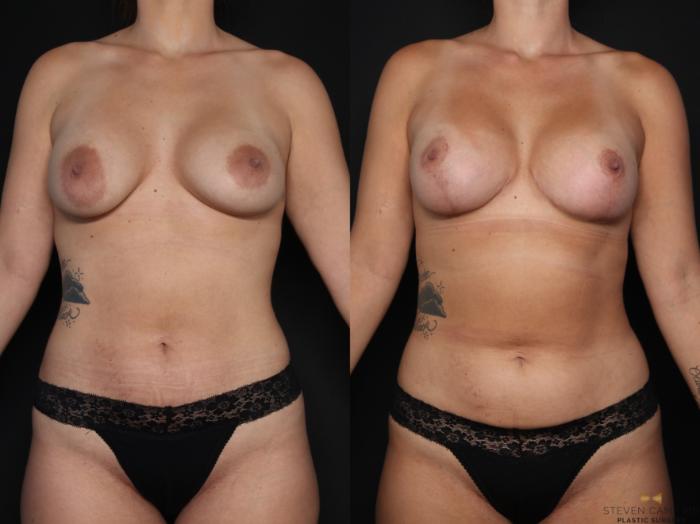 Before & After Internal Bra (Galaflex) Case 677 Front View in Fort Worth & Arlington, Texas