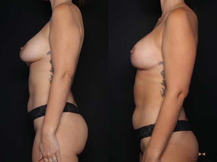 Before & After Breast Implant Exchange (Breast Revision) Case 677 Left Side View in Fort Worth & Arlington, Texas