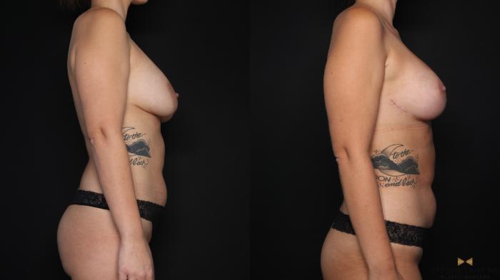 Before & After Breast Implant Exchange (Breast Revision) Case 677 Right Side View in Fort Worth & Arlington, Texas