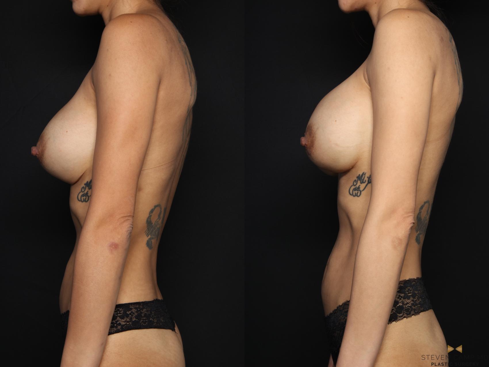 Before & After Breast Implant Exchange (Breast Revision) Case 706 Left Side View in Fort Worth & Arlington, Texas