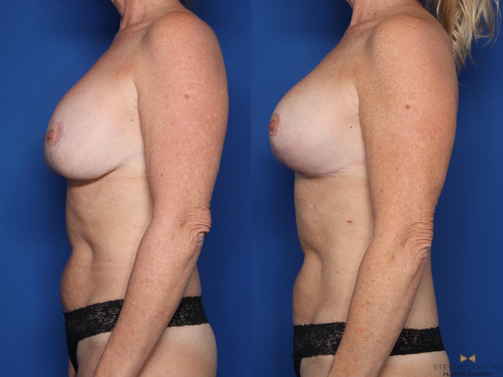 Before & After Breast Implant Exchange (Breast Revision) Case 707 Left Side View in Fort Worth & Arlington, Texas