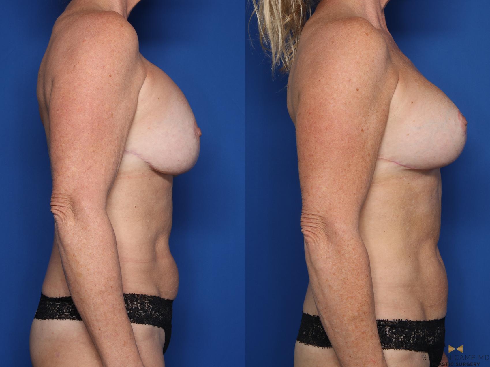 Before & After Breast Implant Exchange (Breast Revision) Case 707 Right Side View in Fort Worth & Arlington, Texas