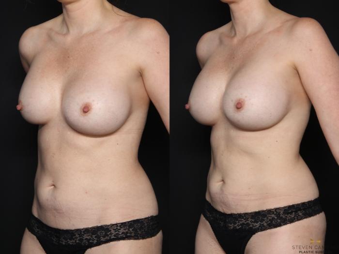 Before & After Breast Implant Exchange (Breast Revision) Case 710 Left Oblique View in Fort Worth & Arlington, Texas