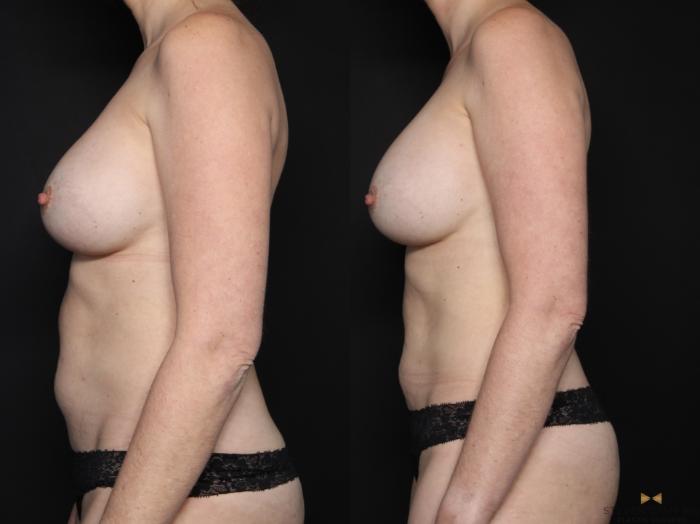 Before & After Breast Implant Exchange (Breast Revision) Case 710 Left Side View in Fort Worth & Arlington, Texas