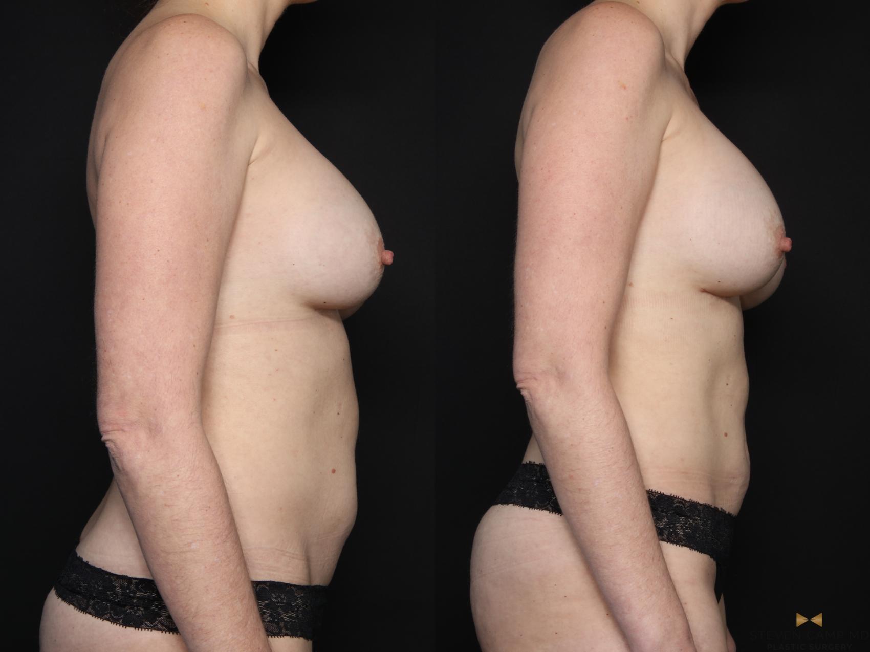 Before & After Breast Implant Exchange (Breast Revision) Case 710 Right Side View in Fort Worth & Arlington, Texas