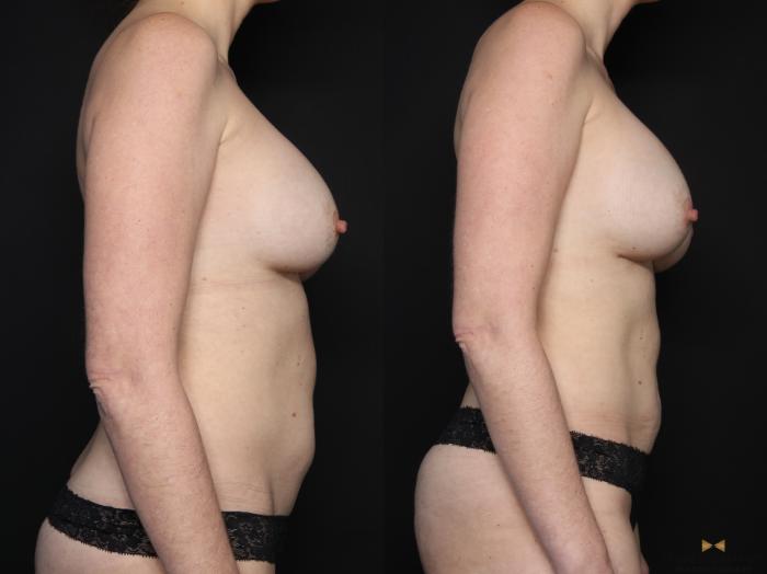 Before & After Breast Implant Exchange (Breast Revision) Case 710 Right Side View in Fort Worth & Arlington, Texas