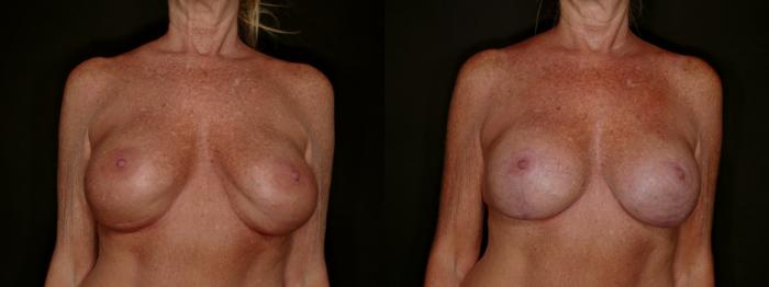 Before & After Breast Implant Exchange (Breast Revision) Case 800 Front View in Fort Worth & Arlington, Texas