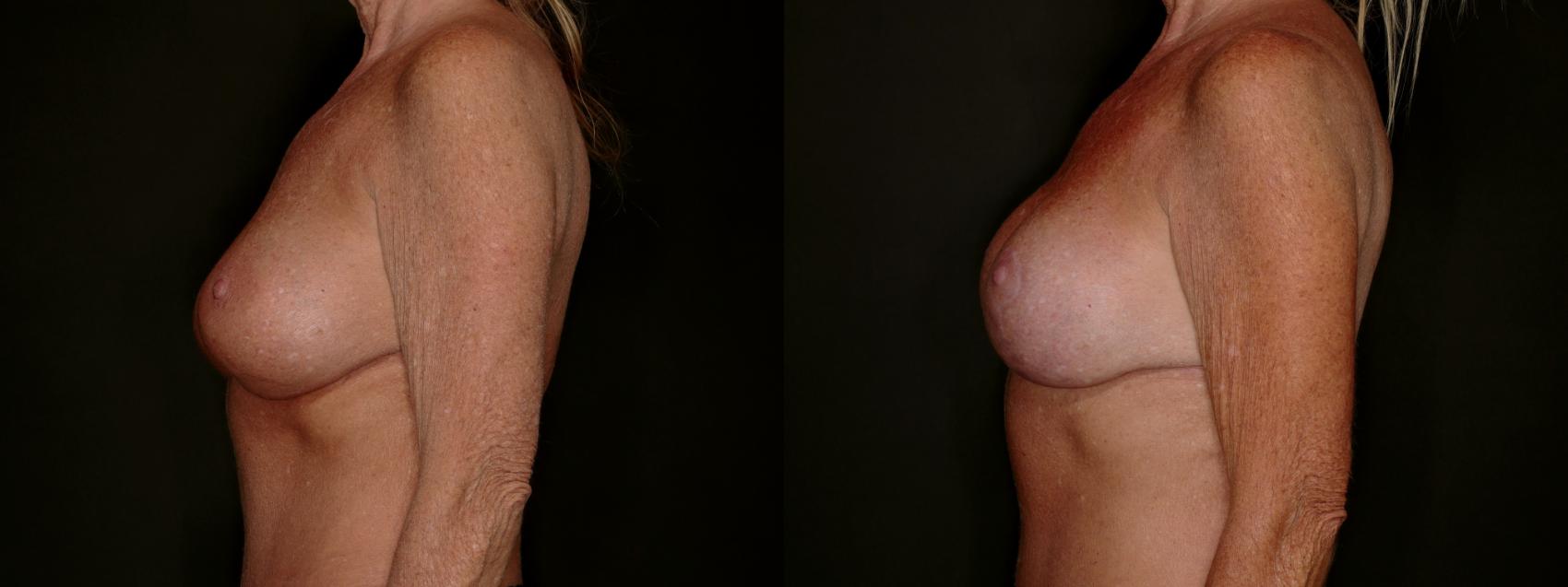 Before & After Breast Implant Exchange (Breast Revision) Case 800 Left Side View in Fort Worth & Arlington, Texas