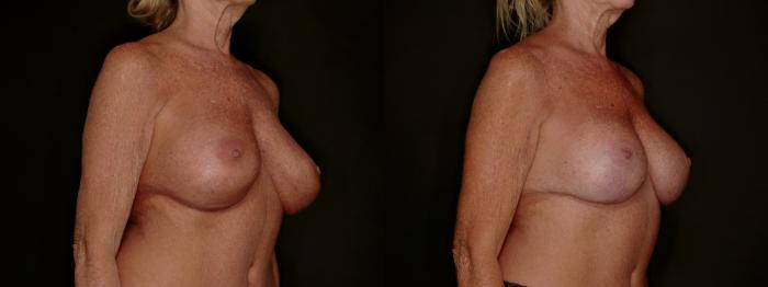 Before & After Breast Implant Exchange (Breast Revision) Case 800 Right Oblique View in Fort Worth & Arlington, Texas