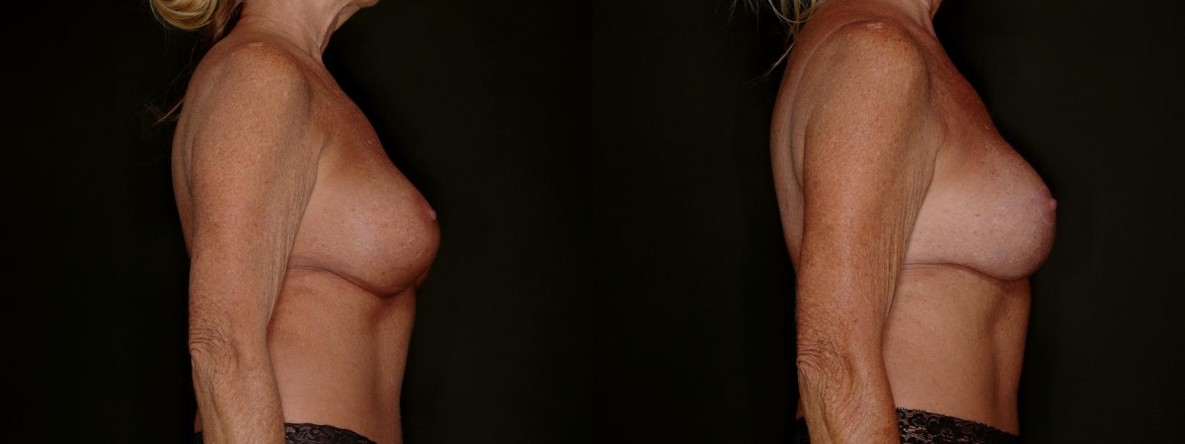 Before & After Breast Implant Exchange (Breast Revision) Case 800 Right Side View in Fort Worth & Arlington, Texas