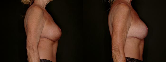 Before & After Breast Implant Exchange (Breast Revision) Case 800 Right Side View in Fort Worth & Arlington, Texas