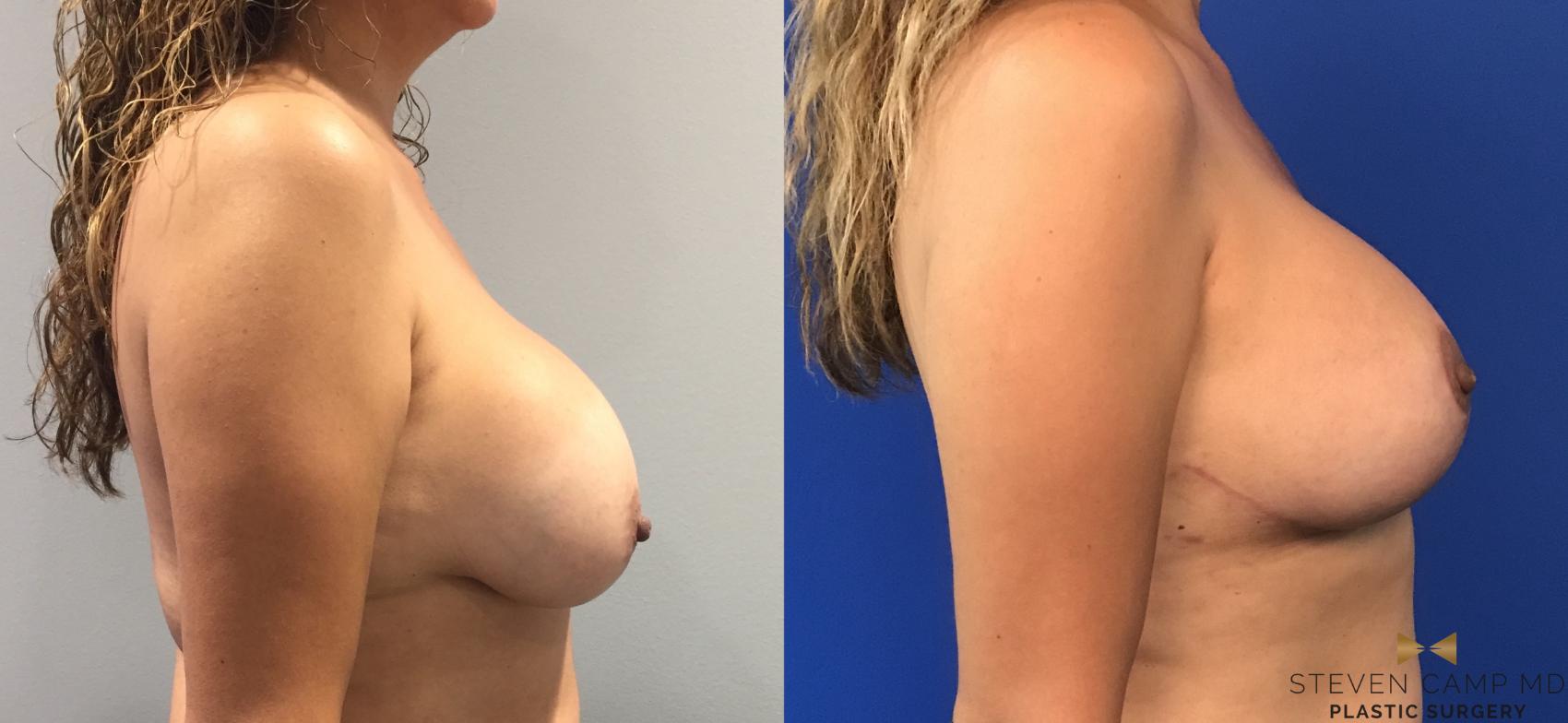 Before & After Breast Implant Exchange (Breast Revision) Case 98 View #5 View in Fort Worth & Arlington, Texas