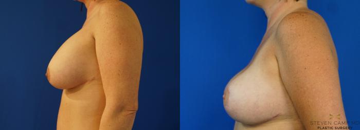 Before & After Breast Implant Exchange, Mastopexy & Internal Bra Case 159 View #3 View in Fort Worth, Texas