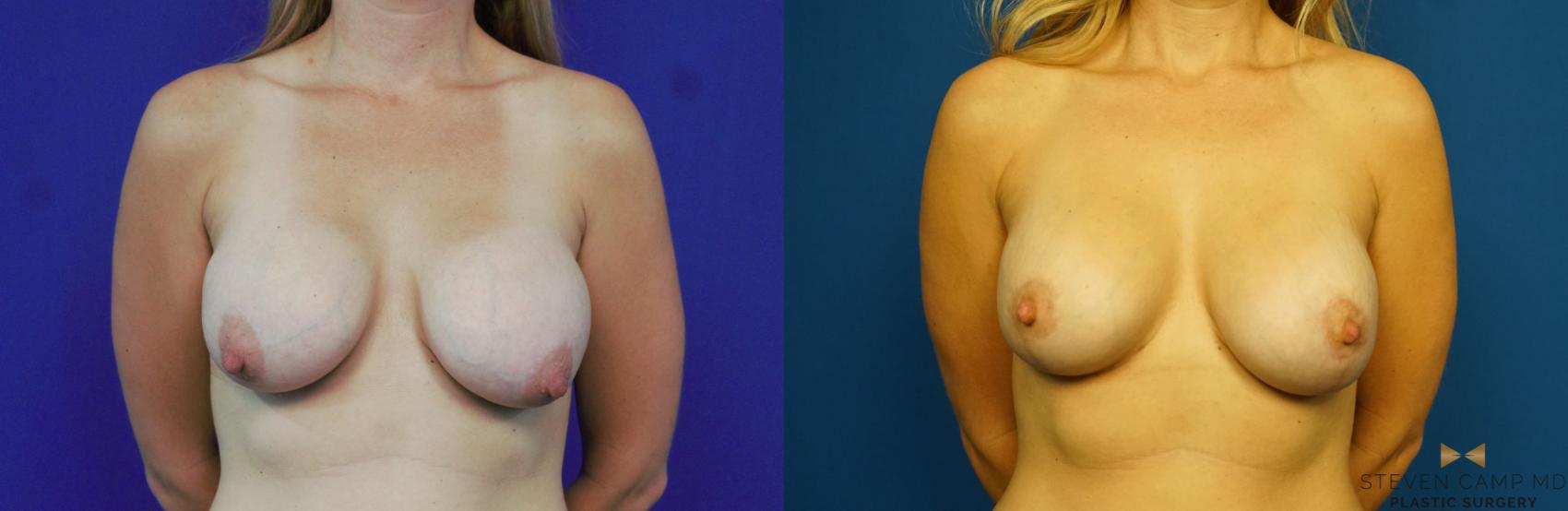 Before & After Breast Implant Exchange (Breast Revision) Case 289 View #1 View in Fort Worth & Arlington, Texas