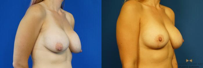 Before & After Breast Implant Exchange (Breast Revision) Case 289 View #2 View in Fort Worth & Arlington, Texas