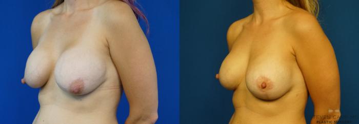Before & After Breast Implant Exchange (Breast Revision) Case 289 View #4 View in Fort Worth & Arlington, Texas