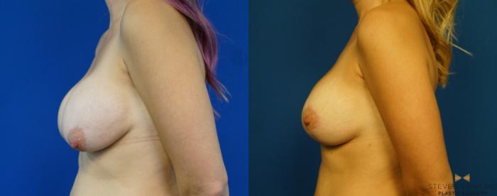 Before & After Breast Implant Exchange (Breast Revision) Case 289 View #5 View in Fort Worth & Arlington, Texas