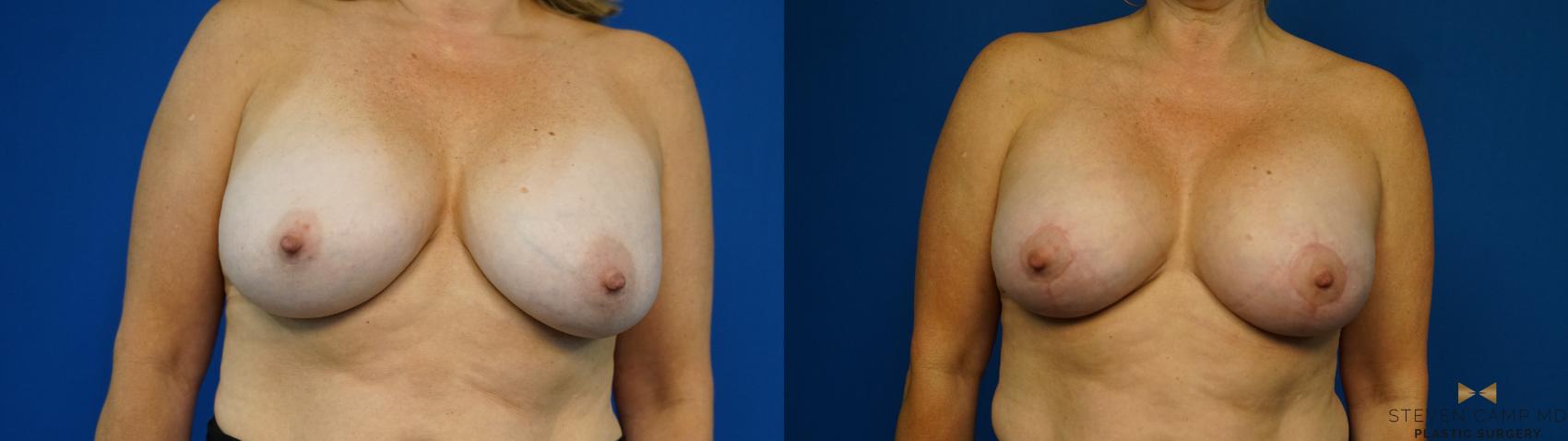 Before & After Breast Implant Exchange (Breast Revision) Case 314 Front View in Fort Worth & Arlington, Texas