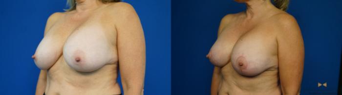 Before & After Breast Implant Exchange (Breast Revision) Case 314 Left Oblique View in Fort Worth & Arlington, Texas