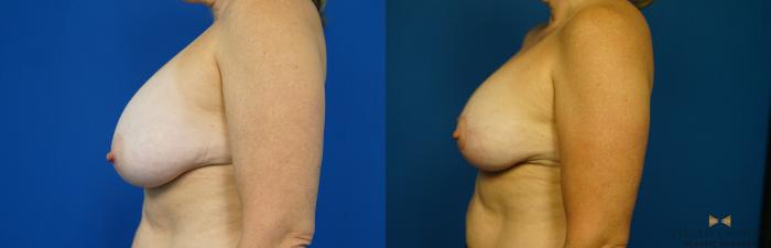 Before & After Breast Implant Exchange (Breast Revision) Case 314 Left Side View in Fort Worth & Arlington, Texas