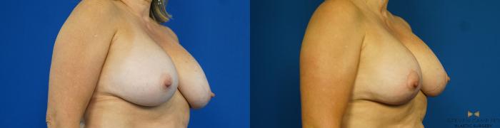 Before & After Breast Implant Exchange (Breast Revision) Case 314 Right Oblique View in Fort Worth & Arlington, Texas