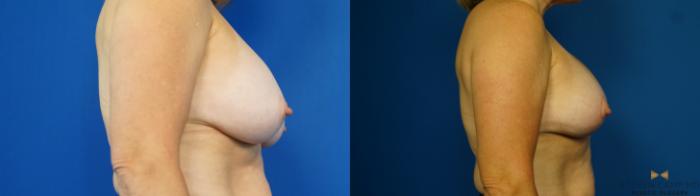 Before & After Breast Implant Exchange (Breast Revision) Case 314 Right Side View in Fort Worth & Arlington, Texas