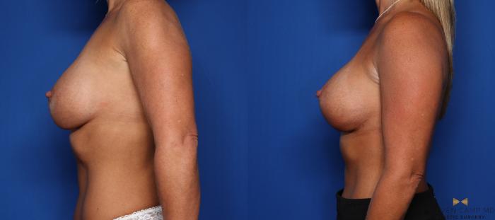 Before & After Breast Lift (Breast Mastopexy with Implants) Case 345 Left Side View in Fort Worth & Arlington, Texas