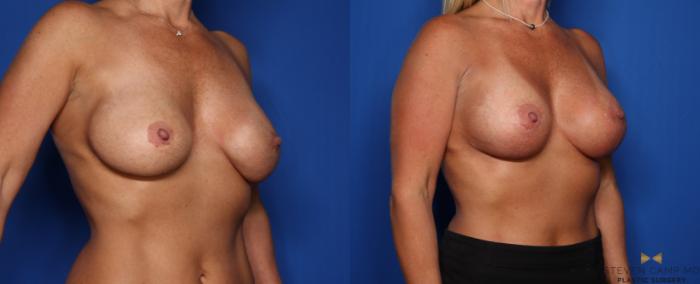 Before & After Breast Implant Exchange (Breast Revision) Case 345 Right Oblique View in Fort Worth & Arlington, Texas