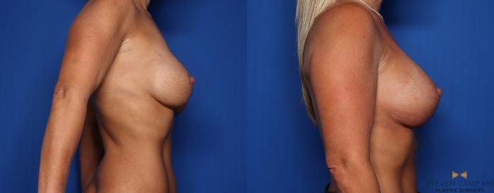 Before & After Breast Lift (Breast Mastopexy with Implants) Case 345 Right Side View in Fort Worth & Arlington, Texas