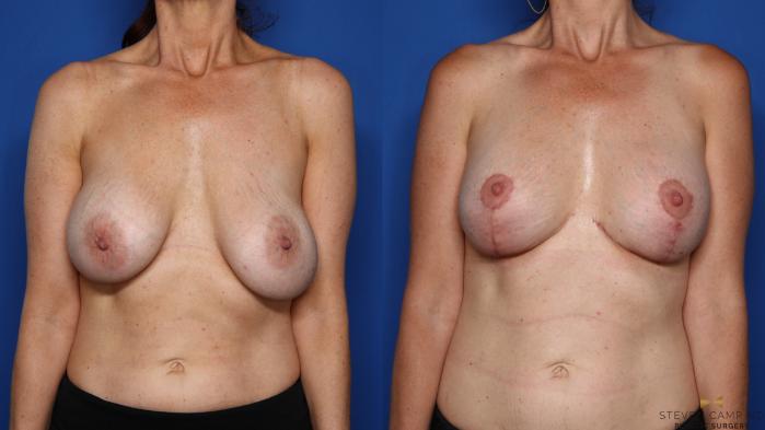 Before & After Breast Implant Exchange (Breast Revision) Case 398 Front View in Fort Worth & Arlington, Texas