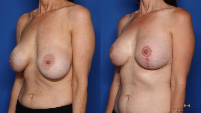 Before & After Breast Lift (Breast Mastopexy with Implants) Case 398 Left Oblique View in Fort Worth & Arlington, Texas