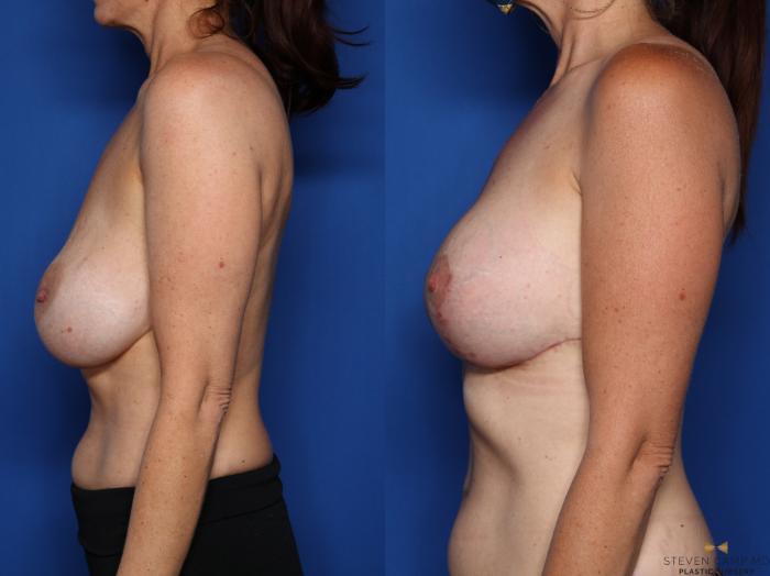 Before & After Breast Lift (Breast Mastopexy with Implants) Case 398 Left Side View in Fort Worth & Arlington, Texas