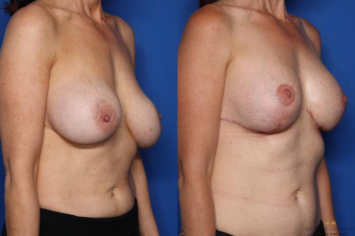 Before & After Breast Implant Exchange (Breast Revision) Case 398 Right Oblique View in Fort Worth & Arlington, Texas