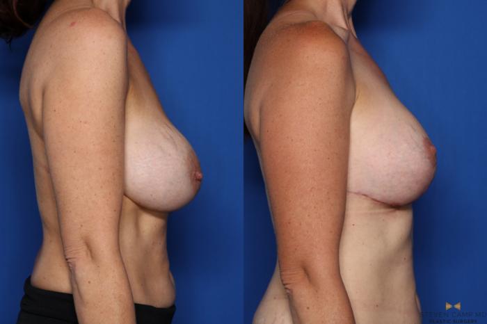 Before & After Breast Implant Exchange (Breast Revision) Case 398 Right Side View in Fort Worth & Arlington, Texas