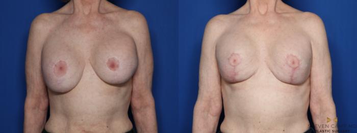 Before & After Breast Implant Exchange, Mastopexy & Internal Bra Case 433 Front View in Fort Worth, Texas