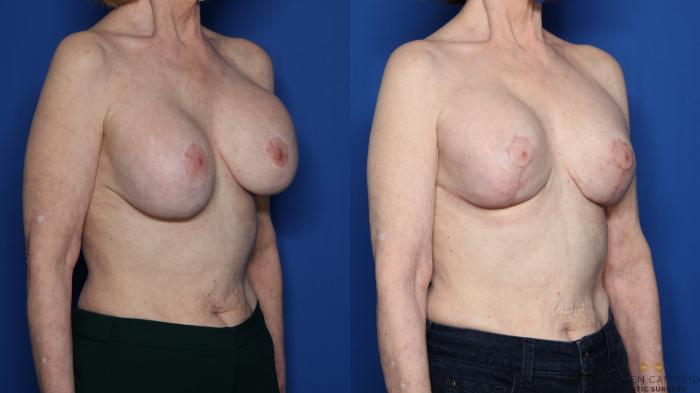 Before & After Breast Implant Exchange, Mastopexy & Internal Bra Case 433 Right Oblique View in Fort Worth, Texas