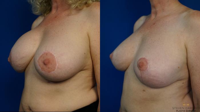 Before & After Breast Implant Exchange (Breast Revision) Case 462 Left Oblique View in Fort Worth & Arlington, Texas