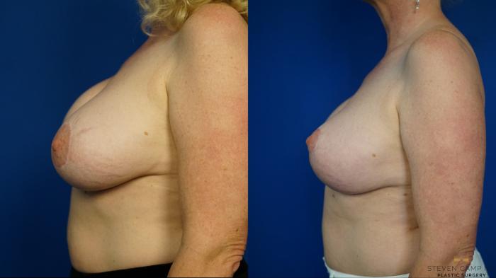 Before & After Breast Implant Exchange (Breast Revision) Case 462 Left Side View in Fort Worth & Arlington, Texas
