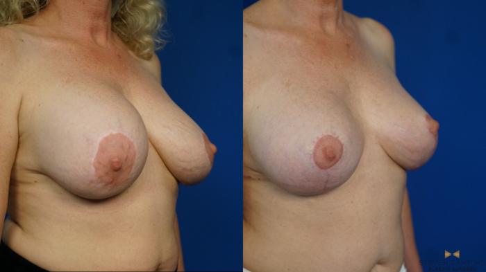 Before & After Breast Implant Exchange (Breast Revision) Case 462 Right Oblique View in Fort Worth & Arlington, Texas