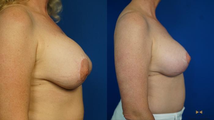 Before & After Breast Implant Exchange (Breast Revision) Case 462 Right Side View in Fort Worth & Arlington, Texas