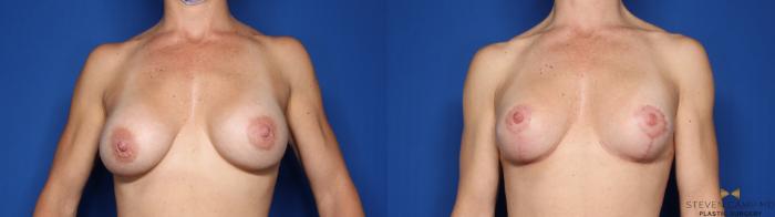 Before & After Breast Implant Exchange (Breast Revision) Case 463 Front View in Fort Worth & Arlington, Texas