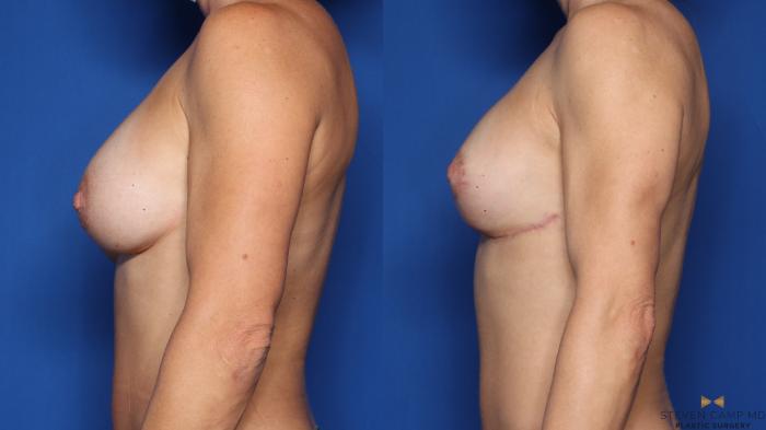 Before & After Breast Implant Exchange (Breast Revision) Case 463 Left Side View in Fort Worth & Arlington, Texas