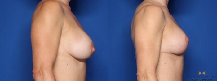 Before & After Breast Implant Exchange (Breast Revision) Case 463 Right Side View in Fort Worth & Arlington, Texas